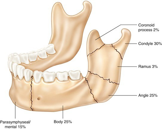 Fraktur Mandibula